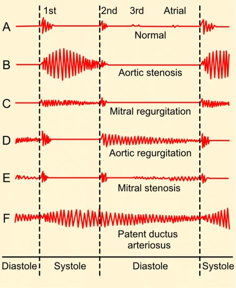 Aortic Regurgitation, Mitral Stenosis, Heart Murmurs, Bicuspid Aortic Valve, Atrial Septal Defect, Aortic Valve Replacement, Cardiac Cycle, Tricuspid Valve, Heart Sounds