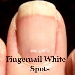 Fingernail White Spots | Health Boundaries White Dots On Nails, White Spots On Fingernails, White Lines On Nails, White Spots On Nails, Fingernail Health, Nail Ridges, Health Signs, Lines On Nails, Nail Health