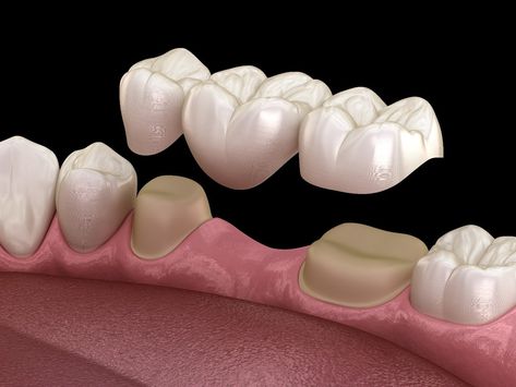 Tooth Bridge, Dental Bridge Cost, Dental Wallpaper, Dental Images, Dental Posters, Human Teeth, Dental Facts, Tooth Replacement, Dental Bridge