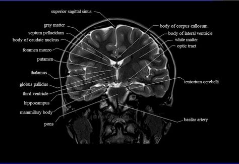 brain anatomy | MRI coronal brain anatomy | free MRI cross sectional anatomy | Brain Mri Scan, Mri Study Guide, Brain Mri, Mri Brain, Vertebral Artery, Radiology Student, Radiology Imaging, Frontal Lobe, Brain Anatomy