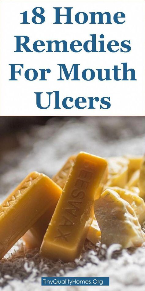 18 Effective Home Remedies For Mouth Ulcers #WhatDoesOralCareMean #HowToTakeCareOfOralHealth Face Rash, Ulcer On Tongue, Ulcer Remedies Mouth, Mouth Ulcer, Baby Acne, Dental Health Care, Dental Cavities, Canker Sore, Early Pregnancy