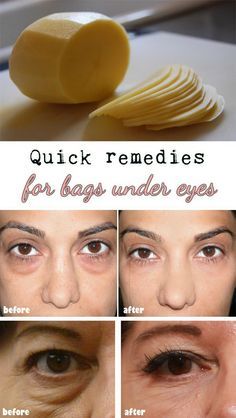 Tuesday's Tip - Natural Solutions to Get Rid of Under-Eye Bags, Dark Circles or Eye Puffiness Puffy Eyes Remedy, Puffy Eye, Bags Under Eyes, Remove Dark Circles, Under Eyes, Dark Circle, Under Eye Bags, Puffy Eyes, Eye Bags