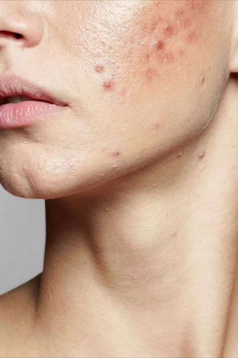 #Acne_Aesthetic #Acne_Photos #Skin_Breakouts #Remove_Skin_Tags_Naturally Acne Aesthetic, Acne Photos, Skin Breakouts, Acne Beauty, Remove Skin Tags Naturally, Face Mapping Acne, Stubborn Acne, Acne Overnight, Acne Face