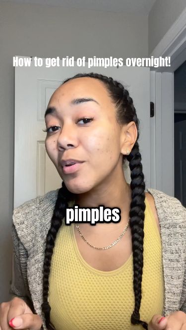 Get rid of pimples OVERNIGHT! Get Rid Of Pimples Overnight, Rid Of Pimples Overnight, Get Rid Of Pimples, Rid Of Pimples, Dry Skincare, Wrinkle Remedies, Pimples Overnight, Get Rid Of Acne, Rid Of Acne