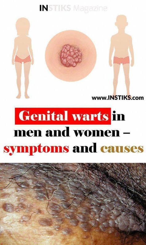 Coldsore Remedies Quick, Home Remedies For Warts, Warts Remedy, Losing 40 Pounds, Get Rid Of Warts, Home Remedy For Cough, Cold Sores Remedies, Natural Sleep Remedies, Natural Cold Remedies