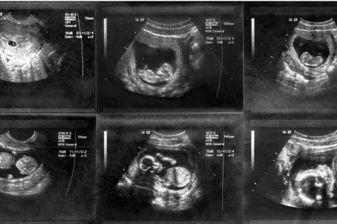 12 Week Ultrasound Pictures, 10 Week Ultrasound Pictures, 5 Weeks Pregnant Ultrasound, 11 Week Ultrasound, 10 Week Ultrasound, 12 Week Ultrasound, Baby Ultrasound Pictures, Pregnancy Scan, 11 Weeks Pregnant