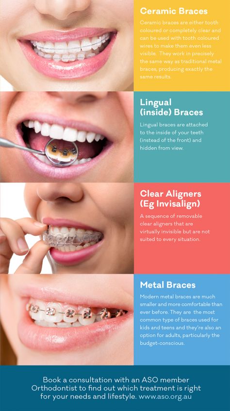 Orthodontic Posters, Type Of Smiles, Different Types Of Teeth, Straighten Teeth Without Braces, Tooth Braces, Different Types Of Braces, Invisible Teeth Braces, Types Of Teeth, Orthodontics Teeth