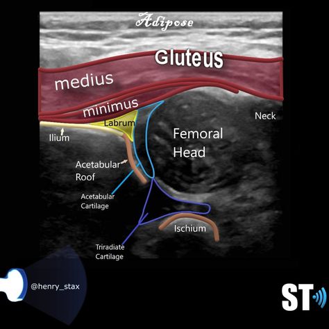 Neonatal Hip Ultrasound – Sonographic Tendencies Developmental Dysplasia Of The Hip, Diagnostic Medical Sonography Student, Ultrasound School, Medical Radiography, Sonography Student, Ultrasound Sonography, Radiology Student, Medical Ultrasound, Diagnostic Medical Sonography