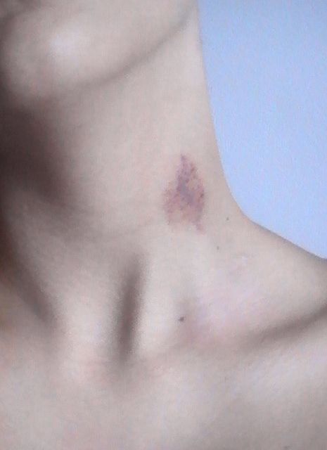 Confession time....how many will admit to the 'Hickey'? Lovebites Mark, Those Were The Days, Oldies But Goodies, After Life, I Remember When, Teenage Years, Sweet Memories, The Good Old Days, Do You Remember