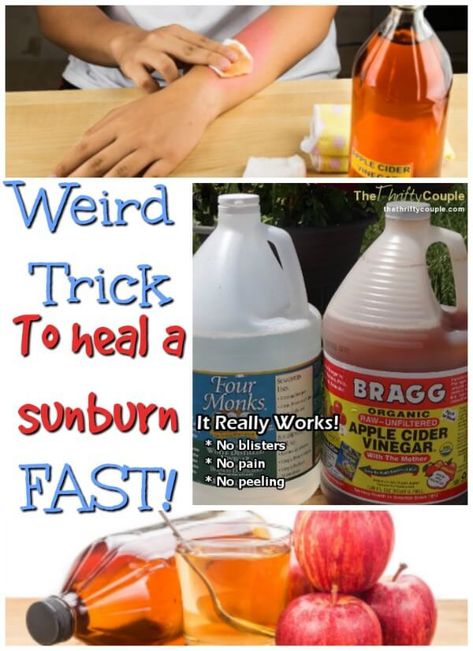 How to Heal A Sunburn (No blisters, No Pain and No peeling) and Turn Into A Tan Naturally and Frugally with Vinegar - It Really Works - The Thrifty Couple Sunburn Face Remedy, Severe Sunburn Relief, Sunburn Relief Instant Diy, Vinegar For Sunburn Relief, How To Heal Sunburn Fast, Sun Burn Remedy Overnight, Home Remedy For Sunburn, Sun Burn Remedy, Heal Sunburn Fast