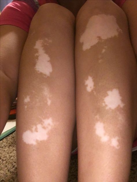 Cool Birthmarks, Vilitigo Skin Aesthetic, Vilitigo Skin, Human Features, Mary Macdonald, Translucent Skin, Medical Textbooks, Old Skin, Skin Marks