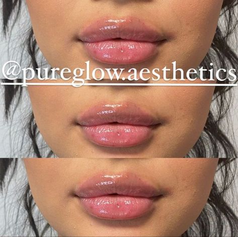 1ml Lip Filler, Dermal Fillers Lips, Lips Inspiration, Lip Types, Face Fillers, Botox Before And After, Botox Lips, Lip Filler, Botox Fillers