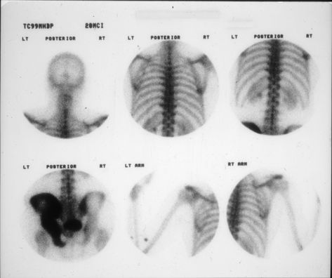 Pagets Disease, Bone Tissue, Chronic Back Pain, Pinched Nerve, Bone Diseases, Chronic Condition, Back Pain Relief, Low Back Pain, Bone Health