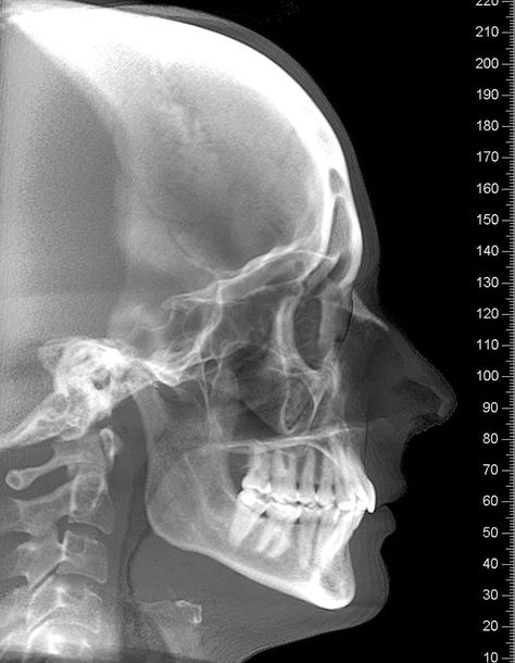 Latest Absolutely Free dental implants xray Thoughts When told by the Academy connected with Basic Dental care, a dental improvement is usually a false oral “ro #Absolutely #dental #Free #implants #Latest #Thoughts #xray Teeth Xray, Free Dental Implants, Implants Dental, Xray Art, Head Anatomy, X Rays, Human Anatomy Art, Dental Implant, A Level Art