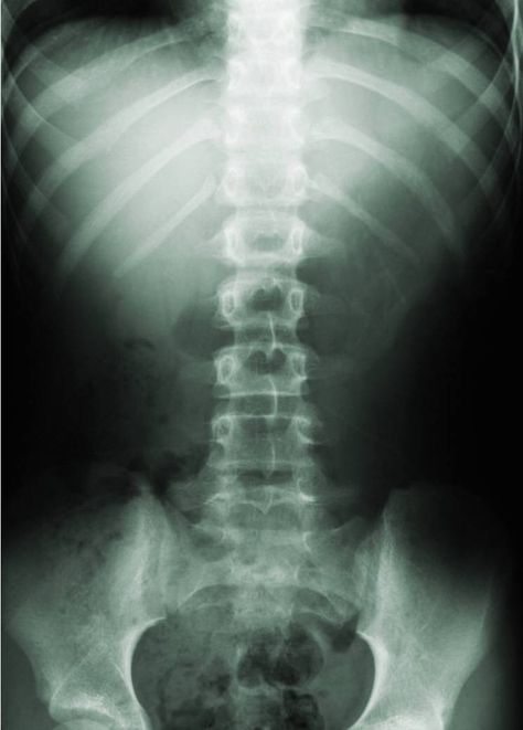 Have a straight Spine. Apologia Biology, Rectus Abdominis, Xray Art, Doctor Of Chiropractic, Inversion Table, Spinal Injury, Personal Injury Lawyer, Chiropractic Care, Back Pain Relief