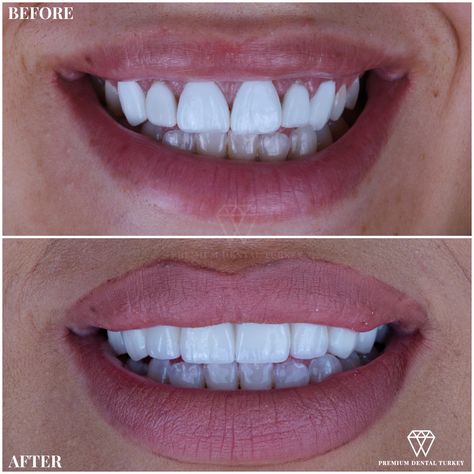 Emax vs Zirconium. Which one is better ? We replaced E.Max Veneers with Zirconium Dental Crowns. Zirconium Crowns Teeth, Hollywood Smile Teeth, Veneer Teeth, Dental Crown Procedure, Emax Veneers, Dental Makeover, Grow Back Receding Gums, Whiten Teeth Fast, Cosmetic Dentistry Veneers