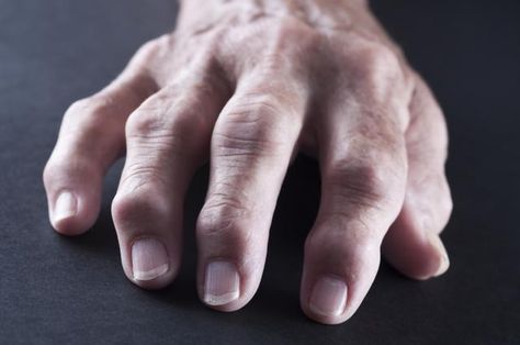 Rheumatoid nodules usually occur in active cases of rheumatoid arthritis. What is the significance of finding a rheumatoid nodule? Rheumatoid Nodules, Joints Pain Relief, Knee Pain, Natural Treatments, Chronic Pain, Natural Remedies, Health, Nails