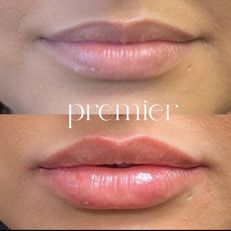 Light Lip Filler, Face Essentials, Dermal Fillers Lips, Lip Blushing, Pretty Teeth, Lips Inspiration, Permanente Make-up, Permanent Eyeliner, Lip Blush