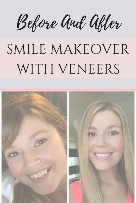 Veneers Before And After, Composite Bonding Teeth Before And After, Dental Veneers Before And After, Veneers Before And After Small Teeth, Celebrity Teeth, Cosmetic Dentistry Before And After, Perfect Smile Teeth Porcelain Veneers, Story Review, Straight Smile