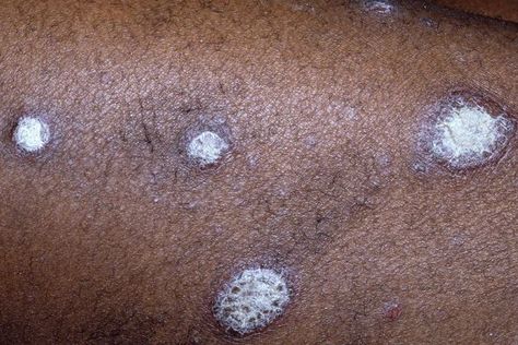 Physicians in the United States aren’t adequately trained to recognize skin symptoms in BIPOC patients. Here’s how innovators are taking on the issue. Skin Disease Pictures, Skin Symptoms, Disease Symptoms, Nickel Allergy, Black Patch, Black Person, Skin Diseases, Dermatologist Recommended, Brown Skin