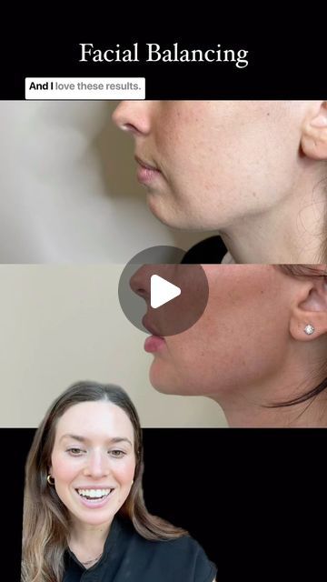 Brett, APRN NP-C • Atlanta injector on Instagram: "Facial balancing for my sister 😆

It’s really cool what facial balancing can do 
Creating overall facial harmony and symmetry ❤️

…

#atlantainjector #facialbalancing #facialbalance #fillerbeforeandafter" Facial Harmony, Facial Balancing Before And After, Facial Balancing, Face Balancing Fillers, Facial Balancing Filler, Botox Face, Atlanta, Facial, Overalls