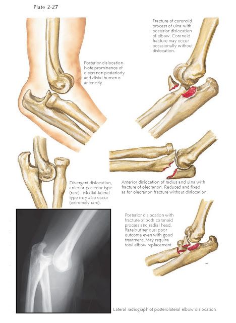 DISLOCATION OF ELBOW JOINT   Dislocations of the elbow joint are the most common dislocations after those of the shoulder and finger join... Elbow Anatomy, Forearm Bones, Elbow Exercises, Radius And Ulna, Outstretched Hand, Types Of Bones, Shoulder Dislocation, Headache Causes, Anatomy Illustration