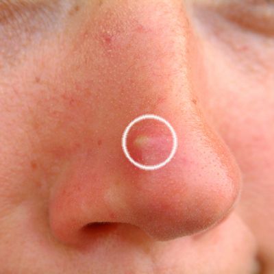 Quick and Effective Way to Remove White Head on Nose [Works] Make a paste of cornstarch and vinegar.  Apply to affected area, wait 15-30 mins, then rinse with warm water. White Heads On Nose, Pimple On Nose, How To Treat Pimples, Whiteheads Remedy, Nose Pimples, Pimple Causes, Varicose Vein Remedy, Blind Pimple, Pimples Under The Skin