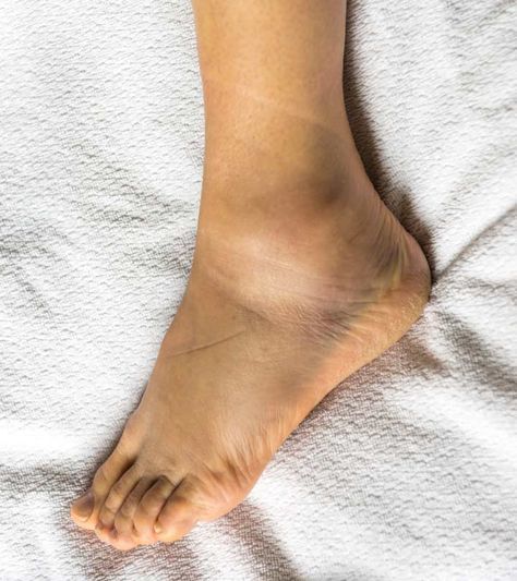 Swelling Feet Remedies, Swelling Remedies, Water Retention Remedies, Swollen Ankles, Back Pain Remedies, Swollen Legs, Relax Your Mind, Home Health Remedies, Water Retention