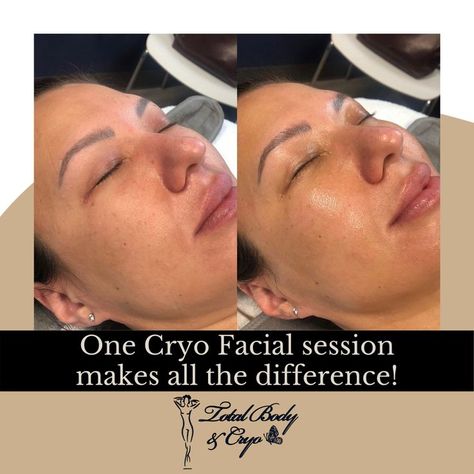 Cryo Facial Before And After, Facial Before And After, Cryo Facial, Skin Care Routine Order, Total Body, Care Routine, Skin Care Routine, Facial, Spa