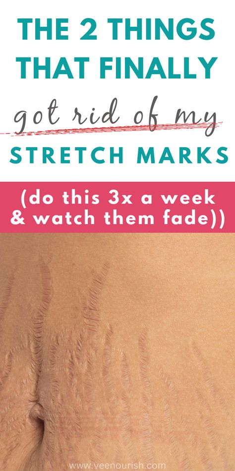 How to fade stretch marks fast | Stretch marks remedies on how to get rid of them Stretch Mark Remedies How To Get Rid, How To Remove Stretch Mark At Home, How To Get Rid Of Strech Marks On Waist, How To Get Rid Of Stench Marks, Castor Oil Stretch Mark, How To Get Rid Of Strech Marks On Thighs, Stretch Mark, How To Get Rid Of Stretchmarks Fast, How To Remove Strechmark