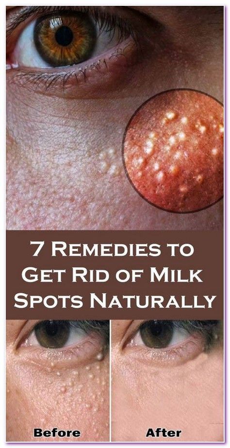 7 Remedies to Get Rid of Milk Spots Naturally Healthy Tricks, Oatmeal Scrub, Health Planner, Skin Disorders, Cosmetic Procedures, Be Healthy, Alternative Medicine, The Skin, Healthy Tips