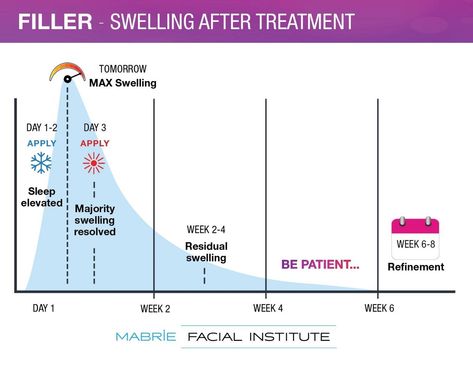 Under Eye/Tear Trough Filler: Everything You Need To Know (Updated 2023) – Mabrie Facial Institute Eye Dermal, Tear Trough Filler, Get Rid Of Eye Bags, Rid Of Eye Bags, Eye Tear, Restylane Lyft, Juvederm Voluma, Under Eye Fillers, Hyaluronic Acid Fillers