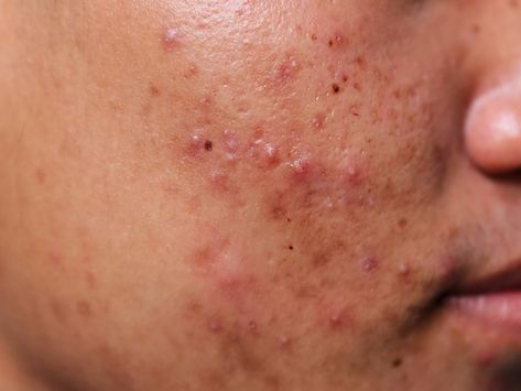 These powerful close-up photos of acne will change the way you think about your skin Acne Photos, Back Acne Remedies, Blind Pimple, Forehead Acne, Pimples Under The Skin, Pimples Remedies, Prevent Pimples, Natural Acne Remedies, Skin Photo