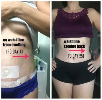 Plus Size Mommy Makeover Surgery, Yummy Tuck Before And After, Panniculectomy Recovery, Tummy Tucks Recovery Timeline, Back Lipo Before And After, Skin Removal Surgery Before And After, Plus Size Tummy Tucks Before And After, Panniculectomy Before And After, Tummy Tucks Before And After