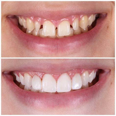 Peg laterals restored with Composite Veneers Composite Veneers Teeth, Teeth Makeover, Composite Bonding, Teeth Aesthetic, Dental Advertising, Composite Veneers, Veneers Teeth, Manifesting Vision Board, Dental Fillings