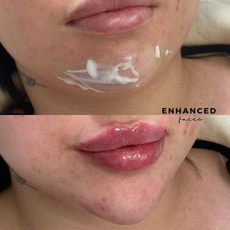 Pointy Chin, Chin Jaw Filler, Pixie Tip Lift Nose Filler, Chin Filler Injection, Lip Fillers Hyaluron Pen, Hyaluron Pen Lip Filler, Chin Filler, Lips Inspiration, Facial Aesthetics