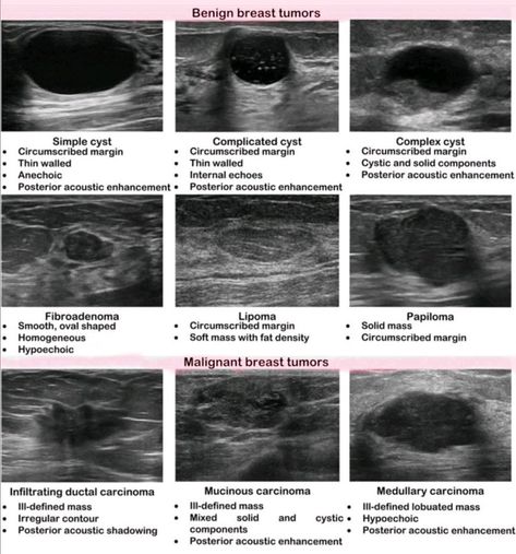 Ultrasound Abdomen Boards, Breast Ultrasound Image, Diagnostic Medical Sonography Student Notes, Ultrasound Tech Notes, Sonography Student Study, Sonogram Technician, Diagnostic Medical Sonography Student, Ultrasound School, Ultrasound Physics