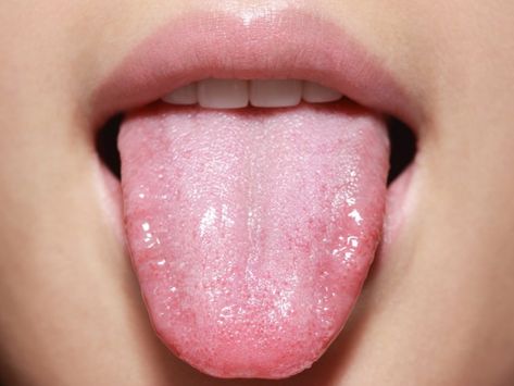 '...too many flavours in the air or on the tongue...' Healthy Tongue, Constant Headaches, Tongue Health, Nail Care Tips, Chatelaine, Oral Hygiene, Our Body, Home Remedies, Nail Care