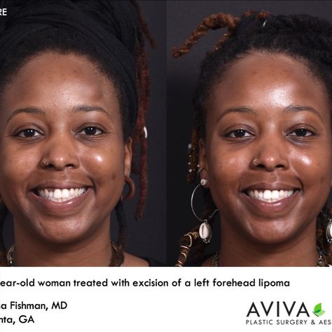 This lovely 28-year-old woman was bothered by a bump on her forehead, and sought the help of our facial plastic surgeon, Dr. Inessa Fishman, and had a surgical removal of the lesion in the office. The bump turned out to be a #lipoma, or a benign fatty tumor. The patient is now bump-free, and has no visible scars on her face, as her incision is carefully hidden in her hair. Want to see more of our before and after photos? Clink on the link below! Lipoma Removal, Lip Augmentation, Facial Plastic, 28 Years Old, After Photos, Plastic Surgeon, Plastic Surgery, Bump, Her Hair