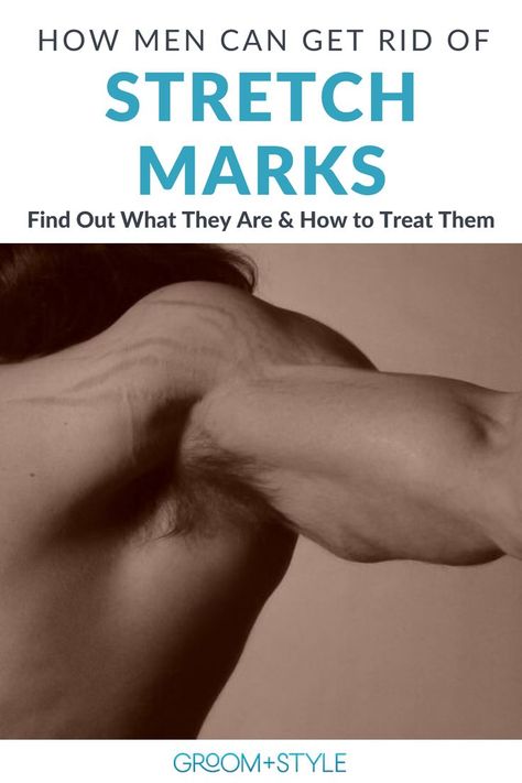 We tend to think of stretch marks as something which only affect women, too, but that’s not true. Stretch marks may be more common in women, but men can, and do, get stretch marks — it all comes down to skin elasticity. Here are our best tips to help men get rid of stretch marks! Strech Marks, Stretch Mark Remedies, Marks Cream, Scar Cream, Stretch Mark Removal, Stretch Mark Cream, Muscle Aches, Groom Style, Good Stretches