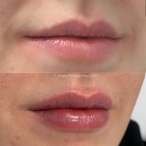 .📍 Melbourne, Australia 🇦🇺.✖ @auskinclinicshighpoint. 👩🏼‍⚕️ Nurse Genevieve. 📷 @injectorperfector_..#lips #dermalfiller #filler #lipfillers #pout #Kiss #cosmeticinjectables #cosmetic #lipinjections #cosmeticdoctor #perfectlips #lipsonpoint #lipenhancement #lipsoftheday #biglips #lipstick #redlips #cosmeticnurse #cosmeticdoctor #lipsonfleek #lipsonpoint #kyliejennerlips #kylielips #lipliner #biglips #lipinjections #lip . Before And After Lip Fillers, After Lip Fillers, Cosmetic Injector, Lips Inspiration, Botox Lips, Large Lips, Dragon Flame, Kylie Jenner Lips, Cosmetic Injectables