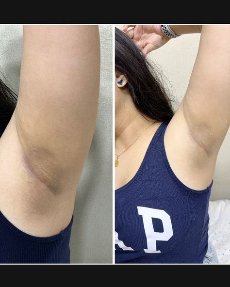 Say goodbye to dark underarms! Just got my underarm peeling done at @DrMinoos, and I’m loving the results 😍✨. The best part? It’s super affordable! If you’re looking for a skincare refresh, this is your sign! 💫 #UnderarmPeeling #SkincareRoutine #AffordableBeauty #DrMinoos #GlowingSkin #BeautyTreatment #SelfCare #WestDelhiBeauty #SmoothSkin #SkincareJourney Dark Armpits, Dark Underarms, Beauty Treatments, After Dark, Say Goodbye, Smooth Skin, Glowing Skin, Skin Care Routine, Skin Care