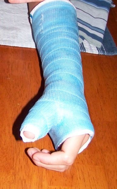 Great tips and insight into life when your child has a broken bone -- pin and save this one just in case! Broken Hand Cast, Wrist Cast, Broken Arm Cast, Packed Bags, Kids Cast, Boo Radley, Arm Cast, Hospital Photography, Hospital Pictures