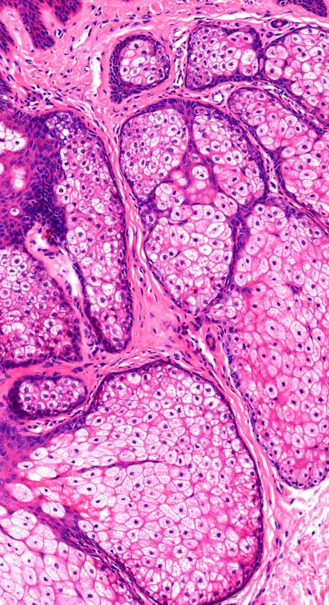 Pathology Wallpaper, Sassy Backgrounds, Histology Aesthetic, Pathology Aesthetic, Biology Background, Sebaceous Hyperplasia, Biology Major, Microscopic Images, Medical School Motivation