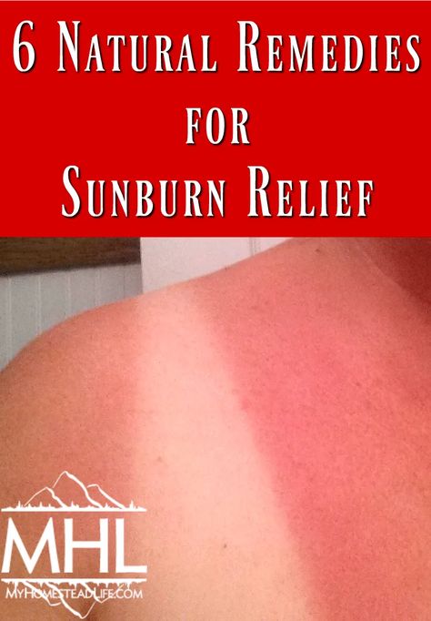 Vinegar For Sunburn, Treating Shingles, Sunburn Blisters, Home Remedies For Sunburn, Aloe Vera For Sunburn, Natural Remedies For Sunburn, Bad Sunburn, Sunburn Skin, Sunburn Remedies