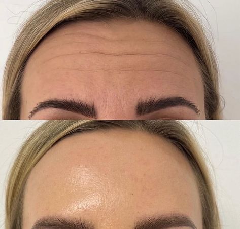 Botox Face Before And After, Masseter Botox Before And After, Botox Before After, Botox Results, Botox Before And After, Botox Face, Botox Cosmetic, Cosmetic Injectables, Instagram Feed Planner