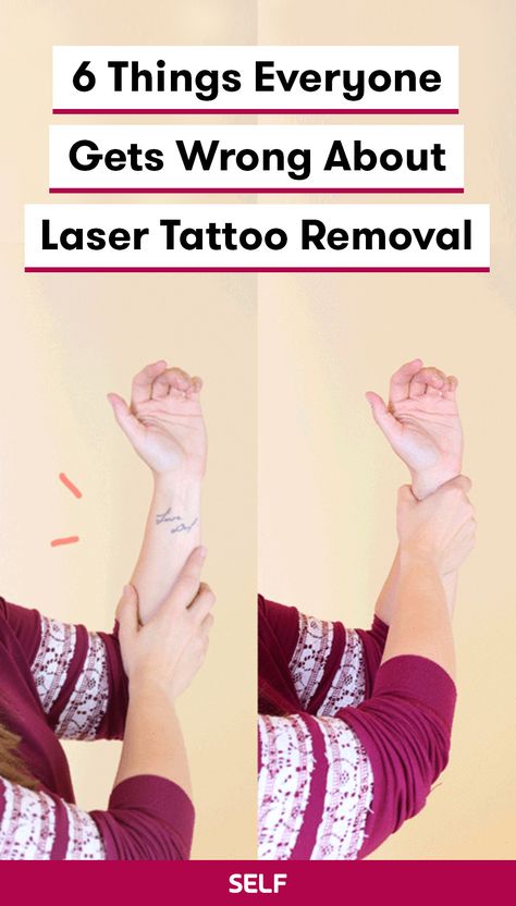 Laser Tattoo Removal Process, Diy Tattoo Removal, Tattoo Removal Before And After, Tattoo Removal Laser, Remove Tattoo, Tattoo Tips, Laser Removal, Bat Tattoo, Omerta Tattoo