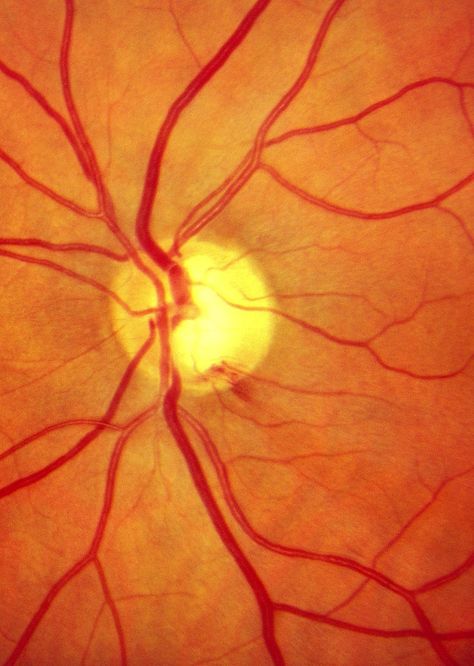 Optic nerve hemorrhage can be a sign of worsening glaucoma with loss of nerve fibers. Diagram Of The Eye, Optician Training, Eye Nerves, Optometry Education, Swollen Eyelid, Element Project, Eye Anatomy, Microscopic Photography, Medical Photography