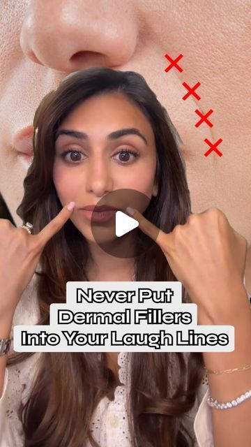 Hudson Derm & Laser Surgery on Instagram: "Instead of injecting dermal fillers directly into your laugh lines, here's what you should know...⁠
⁠
"Laugh lines are a normal anatomic structural part of the face, however, can deepen with age. To soften their appearance, we have to consider the cause of the fold. Overtime, we go through bone resorption, leading to a smaller zygomatic arch. By adding support to the midface, we provide a lifting effect to the cheek, softening the nasolabial fold.⁠
⁠
We support the nasolabial ligament by adding an injection point at the base of the nasal ala. *This is an advanced injection point and should only be performed by a skilled practitioner*⁠
⁠
Believe it or not, the lower face affects the nasolabial fold as well! By supporting the chin, we induce myomodu Nasolabial Folds Dermal Fillers Before And After, Filler Nasolabial Folds, Nasal Labial Folds Filler, Filler For Nasolabial Folds, Laugh Lines Filler Before And After, Nasal Fold Filler Before And After, Nasal Labial Folds Before And After, How To Get Rid Of Laugh Lines, Dermal Fillers Before And After