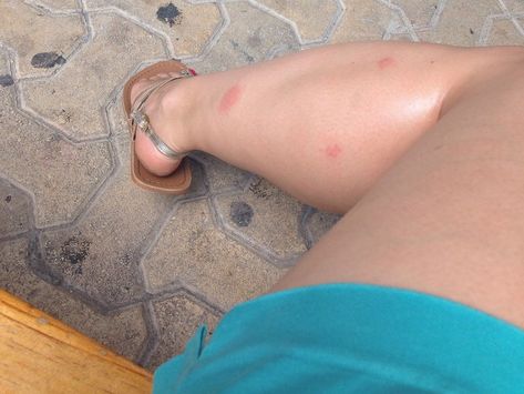 Bite Away Review: Instant Relief From Mosquito Bites Remedies For Mosquito Bites, Elk Island National Park, 2024 Diary, Bite Relief, Wasp Stings, Mosquito Bites, Bug Zapper, Mosquito Bite, Insect Bites